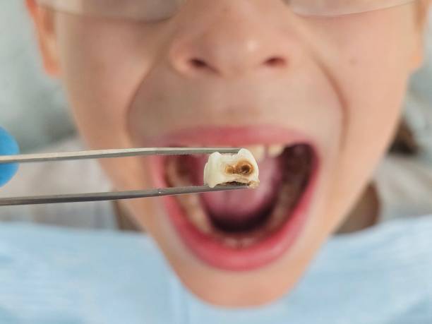 Best Emergency Tooth Extraction in Benton Park, CA